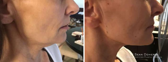NovaThreads Before and After Photos in Boston, MA, Patient 2631