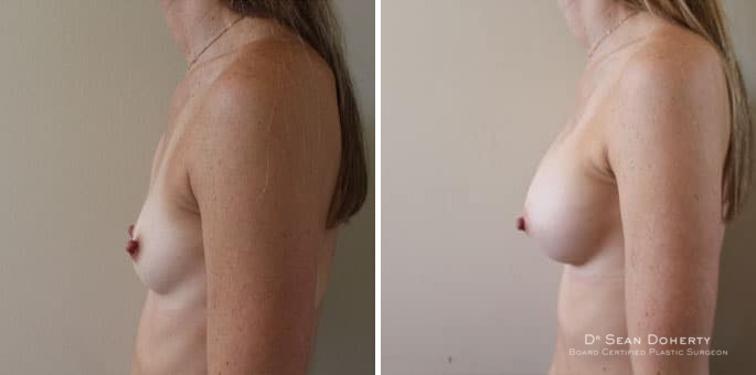 Breast Augmentation Before and After Photos in Boston, MA, Patient 3203