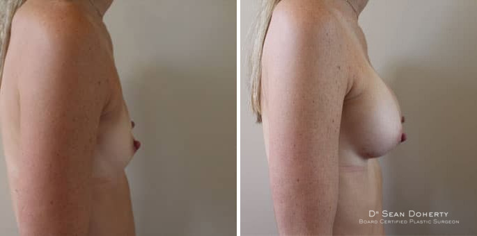 Breast Augmentation Before and After Photos in Boston, MA, Patient 3203