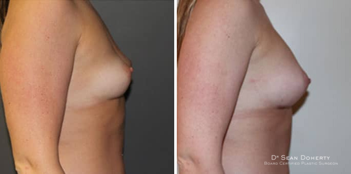 Breast Augmentation Before and After Photos in Boston, MA, Patient 3268