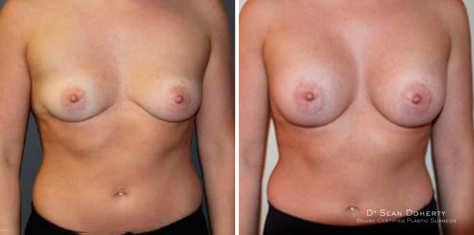 Breast Augmentation Before and After Photos in Boston, MA, Patient 3268