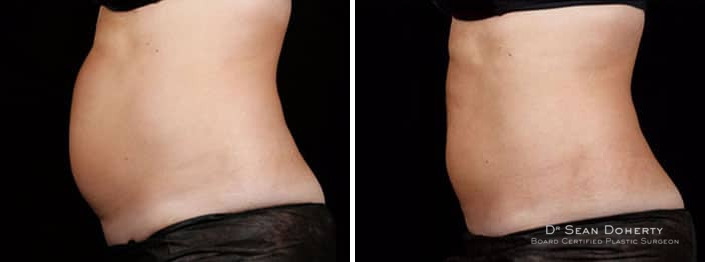 SculpSure Before and After Photos in Boston, MA, Patient 3275