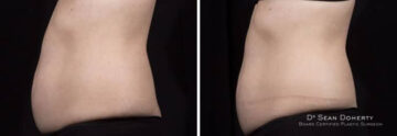 SculpSure Before and After Photos in Boston, MA, Patient 3280