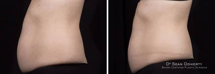 SculpSure Before and After Photos in Boston, MA, Patient 3280
