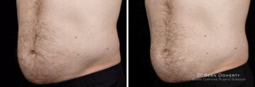 Male SculpSure Before and After Photos in Boston, MA, Patient 3284