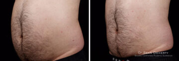 Male SculpSure Before and After Photos in Boston, MA, Patient 3288