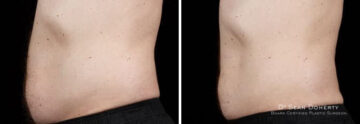 Male SculpSure Before and After Photos in Boston, MA, Patient 3292