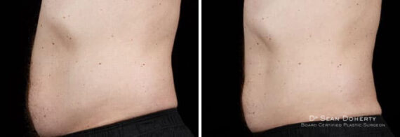 Male SculpSure Before and After Photos in Boston, MA