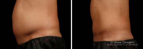 Male SculpSure Before and After Photos in Boston, MA