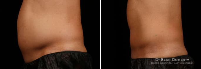 Male SculpSure Before and After Photos in Boston, MA, Patient 3296