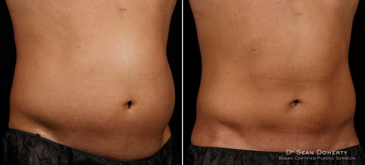 SculpSure Before and After Photos in Boston, MA, Patient 3367