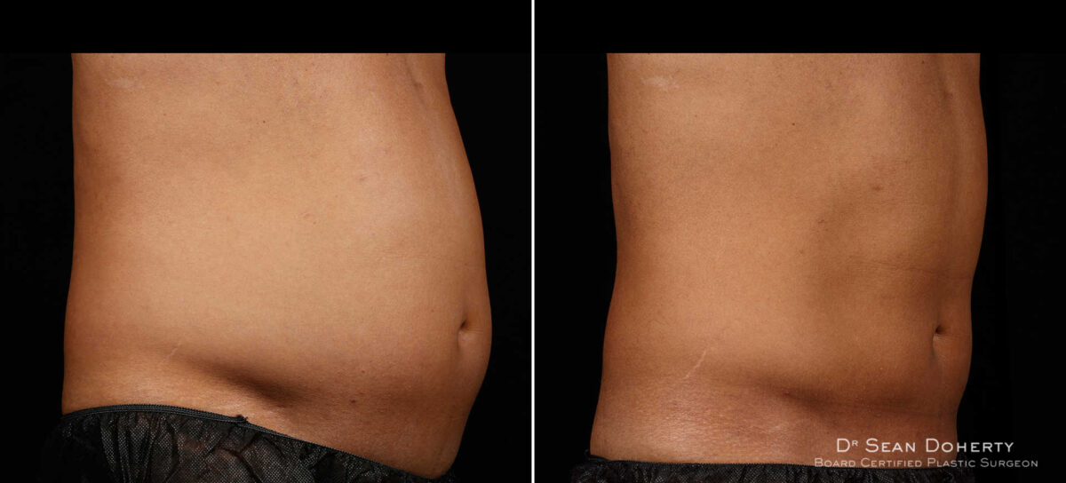 SculpSure Before and After Photos in Boston, MA, Patient 3367