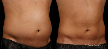 SculpSure Before and After Photos in Boston, MA, Patient 3367