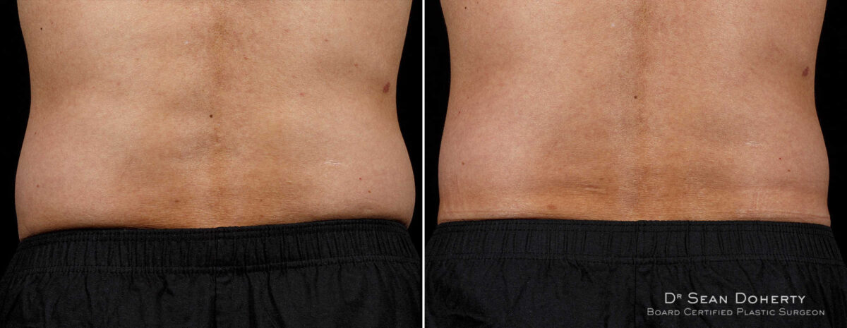 SculpSure Before and After Photos in Boston, MA, Patient 3383