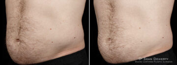 SculpSure Before and After Photos in Boston, MA, Patient 3392