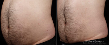 SculpSure Before and After Photos in Boston, MA, Patient 3396