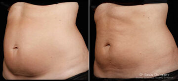 SculpSure Before and After Photos in Boston, MA, Patient 3411