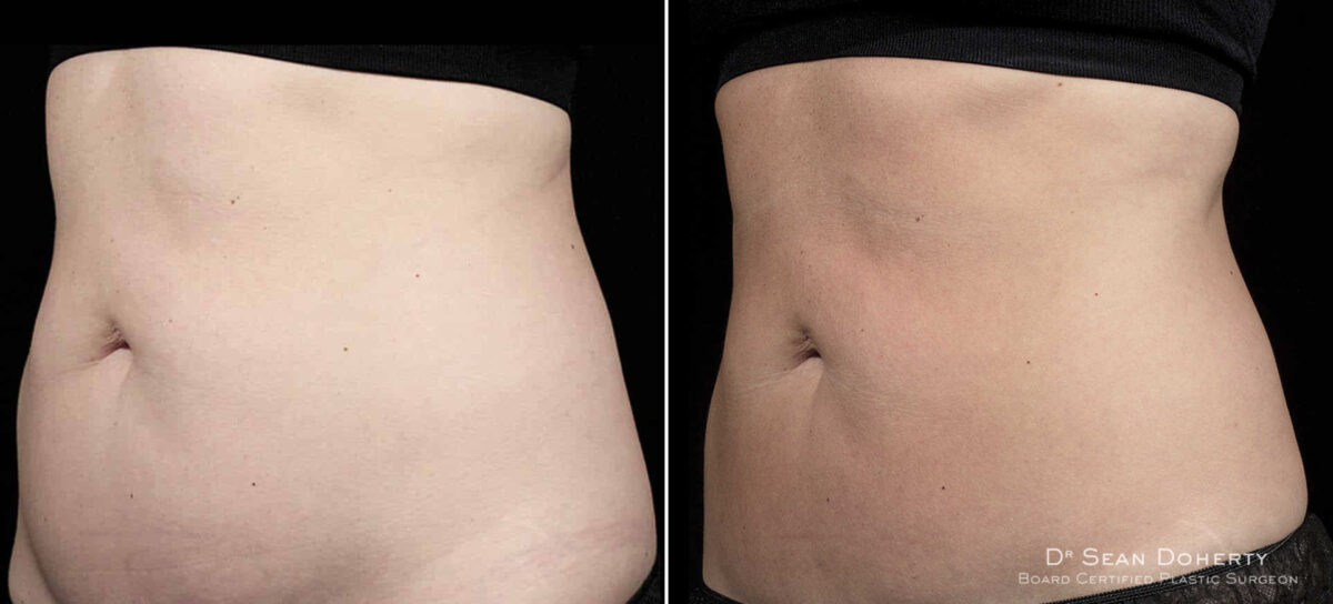 SculpSure Before and After Photos in Boston, MA, Patient 3418