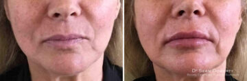 Lip Augmentation Before and After Photos in Boston, MA, Patient 3920