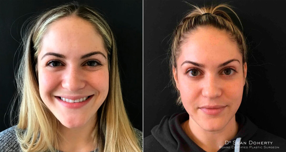 Botox Before and After Photos in Boston, MA, Patient 4030