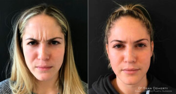 Botox Before and After Photos in Boston, MA, Patient 4030