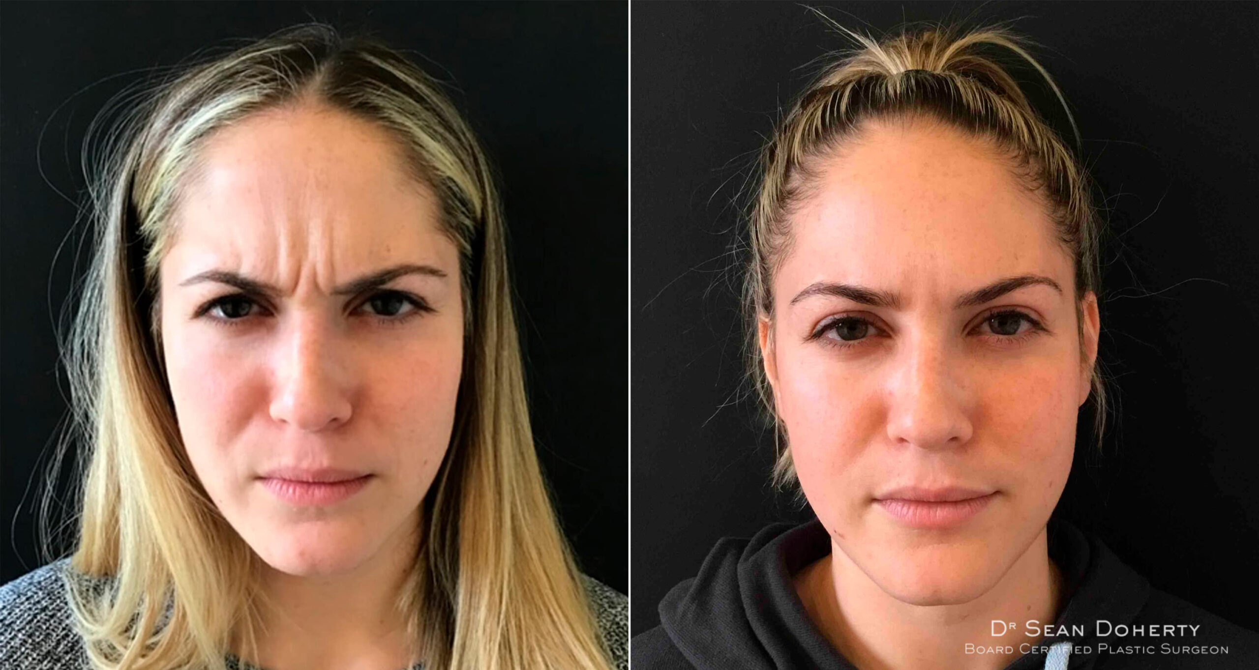 Botox Before and After Photos in Boston, MA, Patient 4030