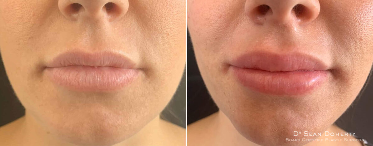 Lip Augmentation Before and After Photos in Boston, MA, Patient 4060