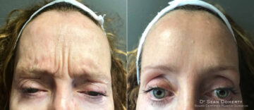 Botox Before and After Photos in Boston, MA, Patient 4074