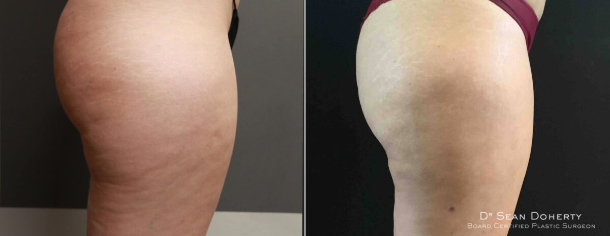 Liposuction Before and After Photos in Boston, MA, Patient 4169