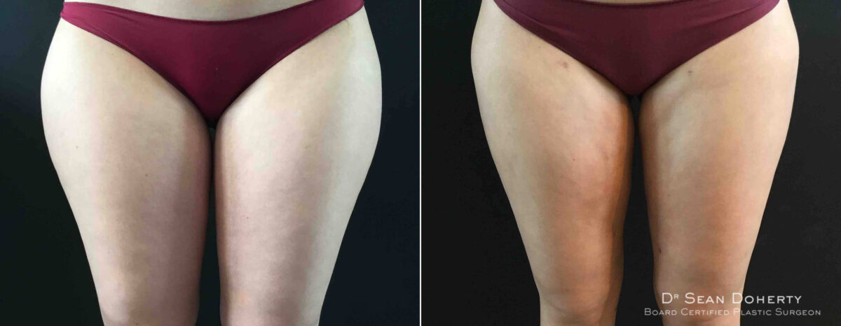 Liposuction Before and After Photos in Boston, MA, Patient 4169
