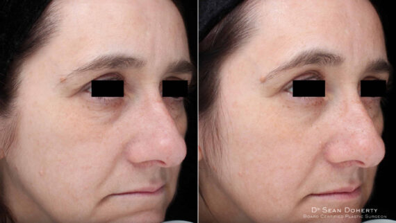 TempSure Before and After Photos in Boston, MA, Patient 4268
