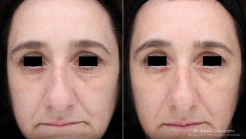 TempSure Before and After Photos in Boston, MA, Patient 4268