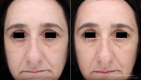 TempSure Before and After Photos in Boston, MA