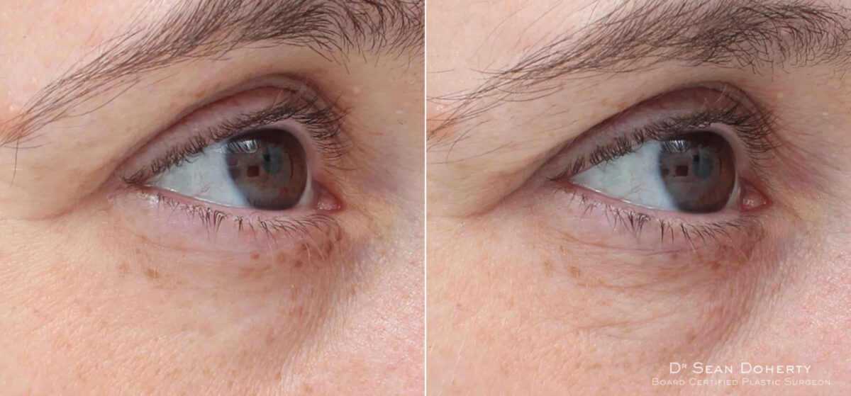 TempSure Before and After Photos in Boston, MA, Patient 4276