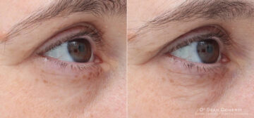 TempSure Before and After Photos in Boston, MA, Patient 4276