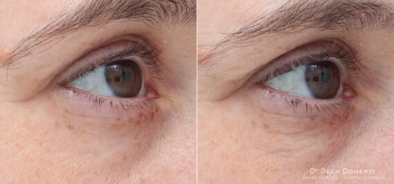 TempSure Before and After Photos in Boston, MA, Patient 4276
