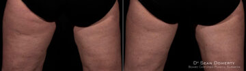 TempSure Before and After Photos in Boston, MA, Patient 4284
