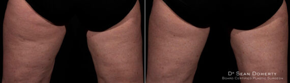 TempSure Before and After Photos in Boston, MA, Patient 4284