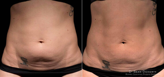 TempSure Before and After Photos in Boston, MA, Patient 4290