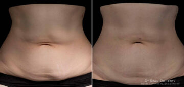 TempSure Before and After Photos in Boston, MA, Patient 4297