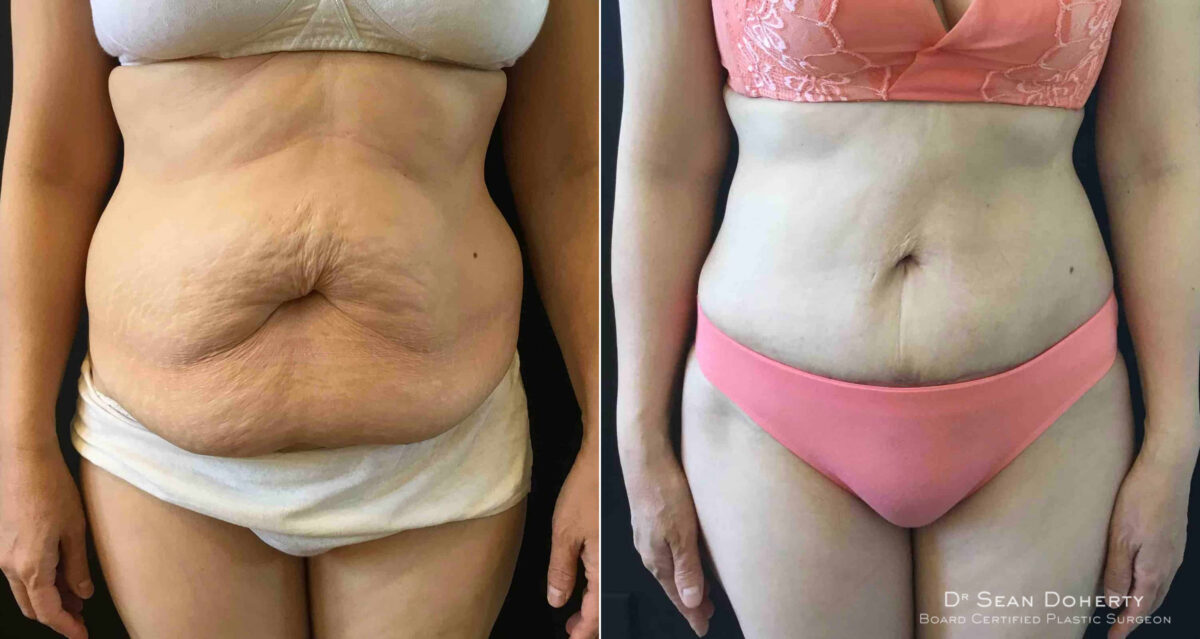 Tummy Tuck Before and After Photos in Boston, MA, Patient 4638