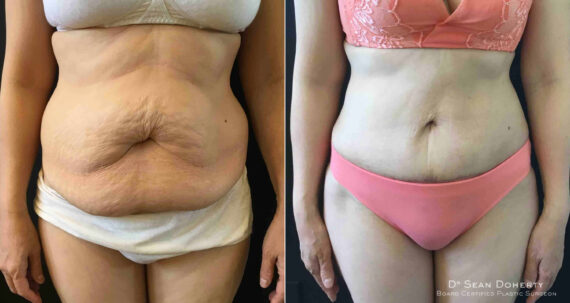 Tummy Tuck Before and After Photos in Boston, MA, Patient 4638