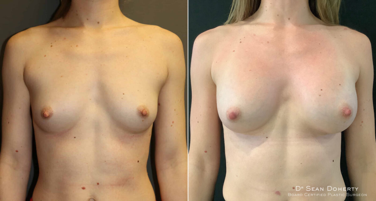 Breast Augmentation Before and After Photos in Boston, MA, Patient 4646