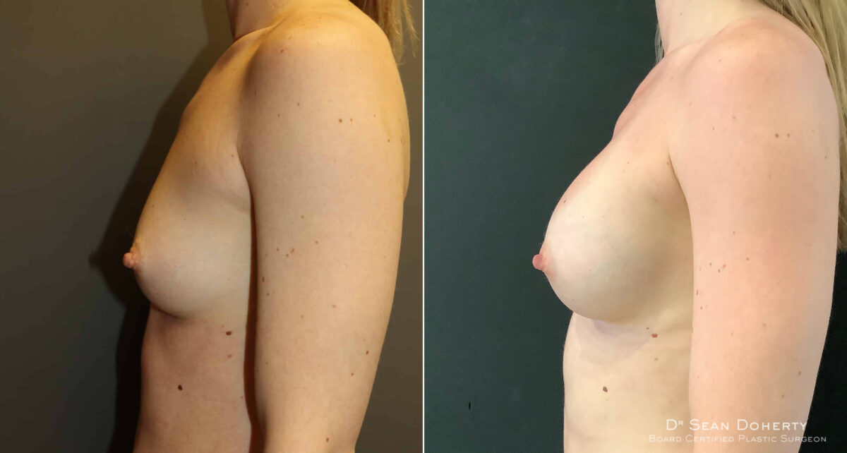 Breast Augmentation Before and After Photos in Boston, MA, Patient 4646
