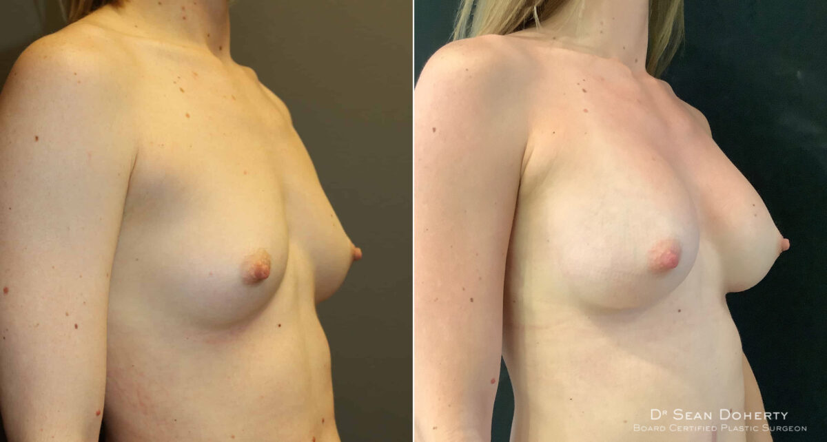 Breast Augmentation Before and After Photos in Boston, MA, Patient 4646