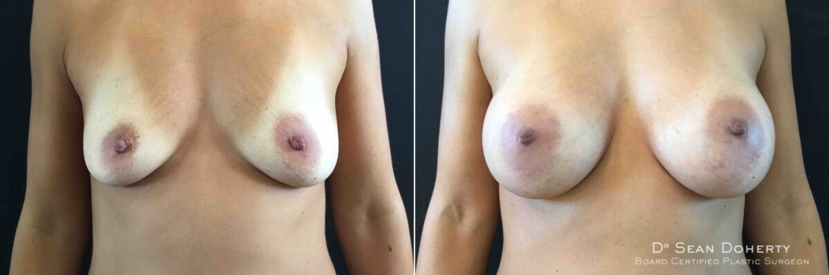 Breast Augmentation Before and After Photos in Boston, MA, Patient 4727