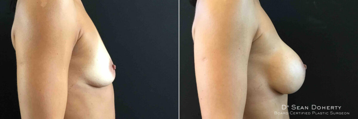 Breast Augmentation Before and After Photos in Boston, MA, Patient 4727