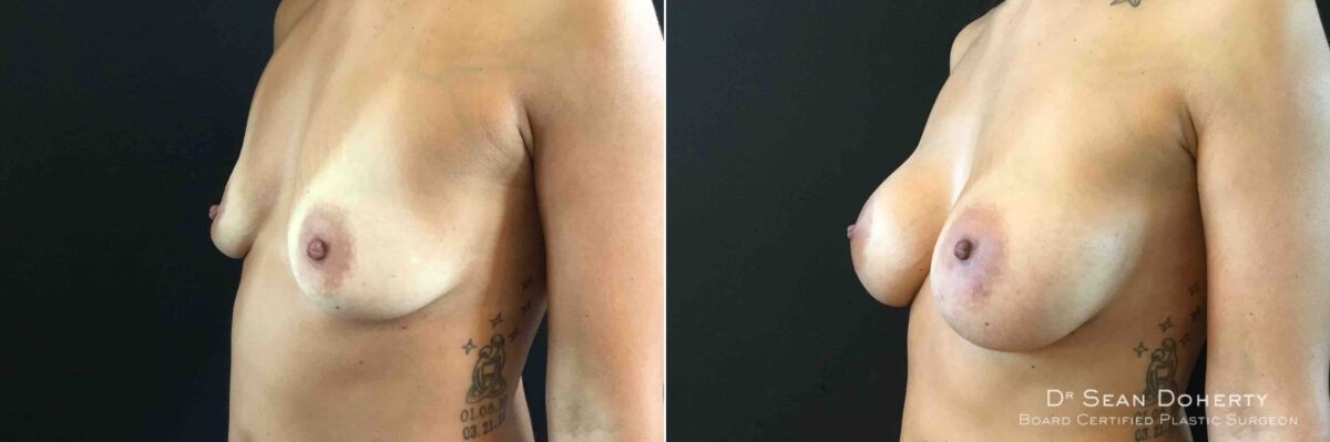 Breast Augmentation Before and After Photos in Boston, MA, Patient 4727