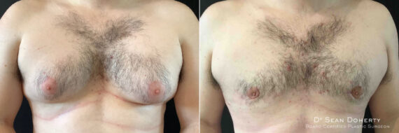 Gynecomastia Before and After Photos in Boston, MA