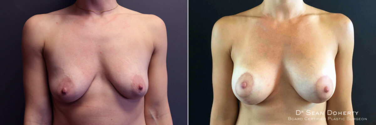 Breast Lift with Implants Before and After Photos in Boston, MA, Patient 5011